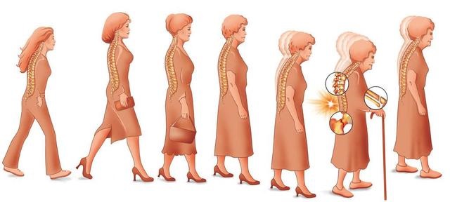 一分鐘測試題目評估你的骨質疏松癥風險